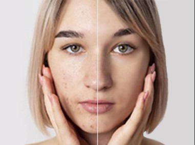 Как убрать прыщи на фото на ПК и телефоне