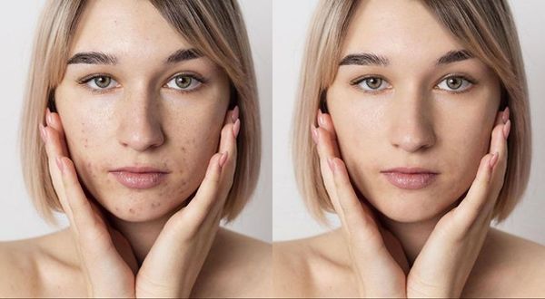 Как убрать прыщи на фото